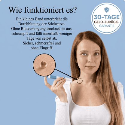 Schmerzfreies Stielwarzen-Entfernungsset